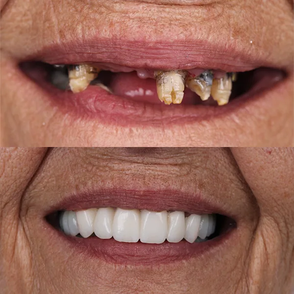Implantes Straumann<br>Calidad y confianza